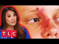 Dr. Lee Needs Extra Help To Remove This Bump &amp; Birthmark! | Dr. Pimple Popper