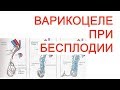 Варикоцеле при бесплодии