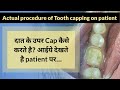आईए देखते है Tooth Capping कैसे करते है? l Tooth Capping Procedure on patient...