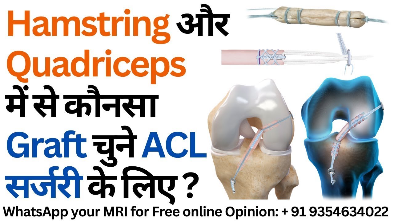 Hamstring Acl Device Hamstring और Quadriceps में से कौनसा Graft चुने ACL Surgery के लिए ...