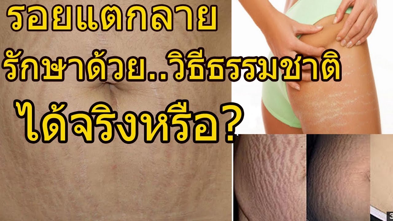 รอยแตกลาย รักษาด้วยวิธีธรรมชาติ ได้จริงหรือ ? - Youtube