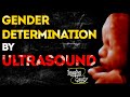 Gender Determination by Ultrasound - Imaging Study Lecture