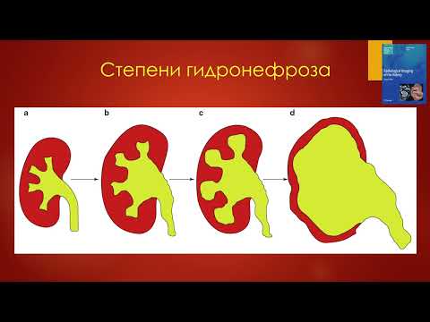 Расширение ЧЛС. УЗ-диагностика. Ультразвук в руках уролога - 2022.