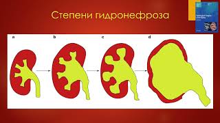 Расширение ЧЛС. УЗ-диагностика. Ультразвук в руках уролога - 2022.