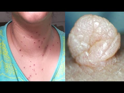 My Sister Did This, Doctors Are Shocked! Just 1 Single Night Remove Skin Tag Mole And Wart Fast
