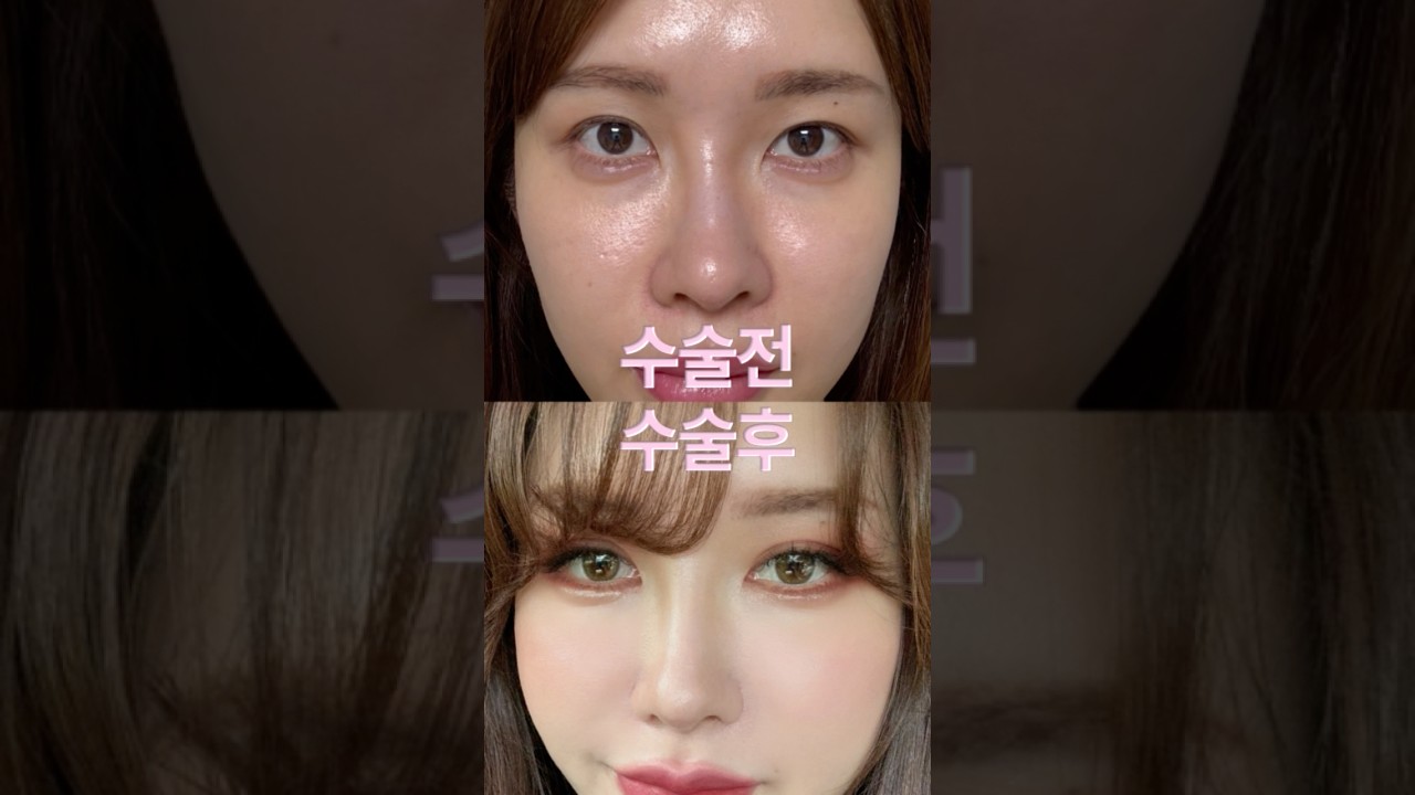 [올로整形外科診所] 非切開式眼型矯正+開眼頭+縮鼻翼 真實前後對比！自然變美的秘訣是什麼？😶 #江南整形外科 #眼型矯正心得 #眼型矯正前後 #眼型矯正 #縮鼻翼 #縮鼻翼心得 #縮鼻翼前後