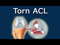 Torn ACL - Definition And Picture