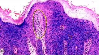 FGT - BOWENOID PAPULOSIS - QUIZ CASE 2 - DIGIPATH TUTORIALS