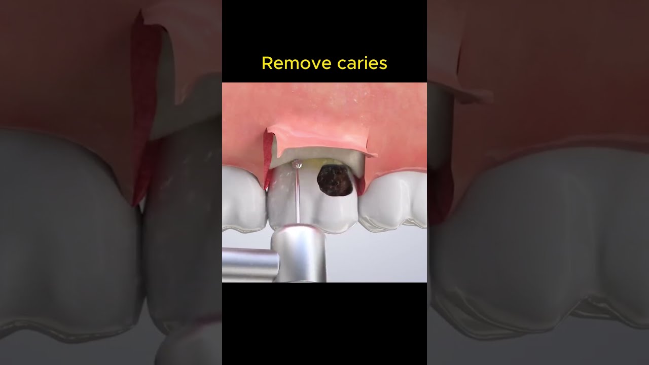 How To Remove Caries 