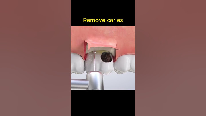 How to remove caries?