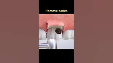 How to remove caries?