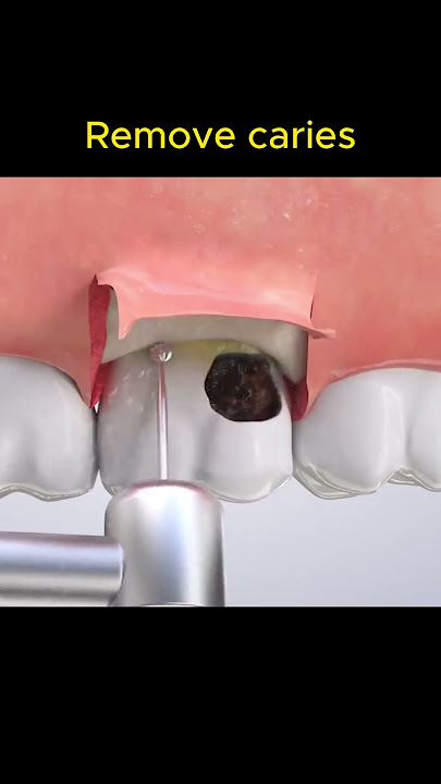 How to remove caries?