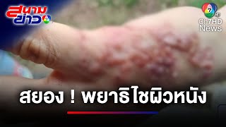 เตือนภัย ! โลกออนไลน์แห่แชร์ พยาธิไชผิวหนัง หลังถอนหญ้า | สนามข่าว 7 สี