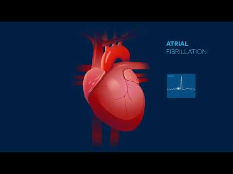 Atrial fibrillation heart rhythm