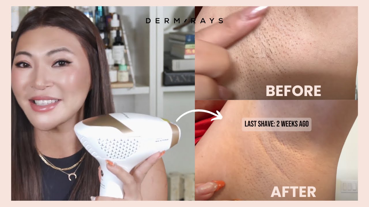 HOME LASER REMOVAL on Bikini Areas & Underarms | Before & After Results!