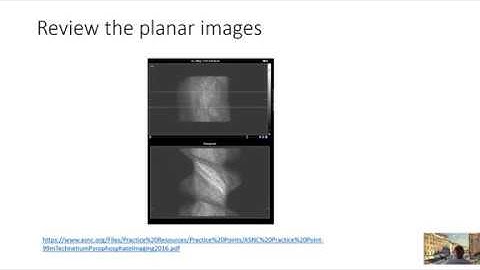 Tc-PYP scan for A-TTR  Cardiac Amyloid