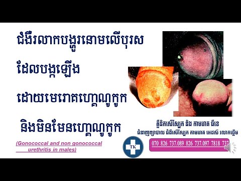 ជំងឺរលាកបង្ហួរនោមលើបុរស-Gonococcal and non gonococcal urethritis in  male