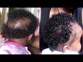 how to grow baby bald spot with rice water and garlic