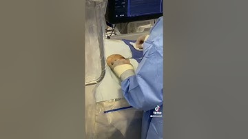 Watchman implant procedure in 1 min ❤️
