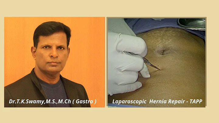 Laparoscopic TAPP Inguinal Hernia Surgery - Dissec...