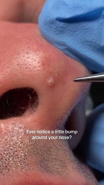 It's called a #fibrouspaoule ‼️ #dermatology #skincare #shorts