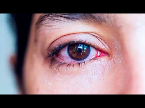 Video: 3 formas de evitar que las pestañas asomen el ojo