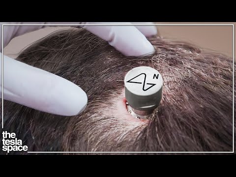 Neuralink Begins Human Trials!