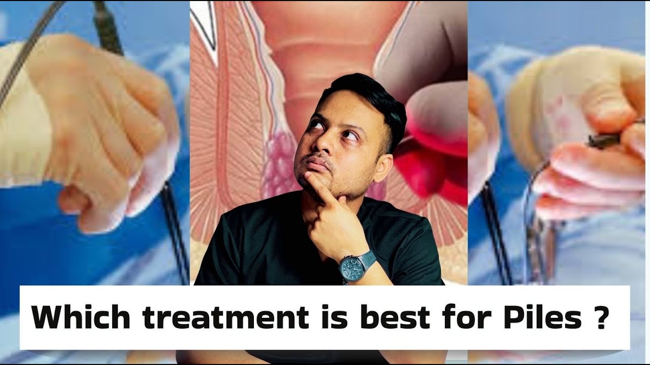 Which Surgery Is Best For Piles? 