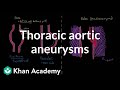Thoracic aortic aneurysms | Circulatory System and Disease | NCLEX-RN | Khan Academy