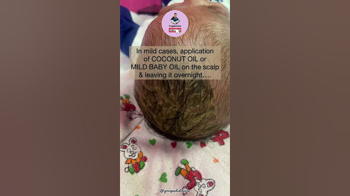 How to get rid of CRADLE CAP on baby's scalp naturally