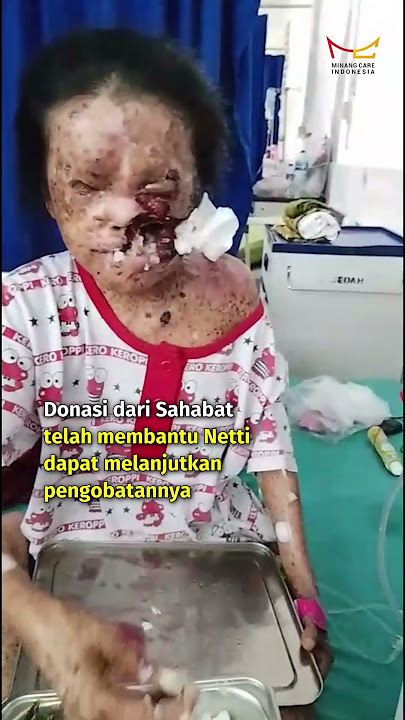 Di Tengah Luka dan Keterbatasan, Netti Tetap Berjuang