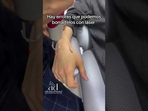 Elimina el tatuaje que ya no deseas