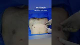 Puffy nipple - Gland removal lahore- chest fat removal Pakistan -Gynecomastia surgery lahore