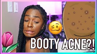 V-Talk 🌷 How To Do A BUTT FACIAL! Getting Rid of Booty Acne, Scars, and Irritation!