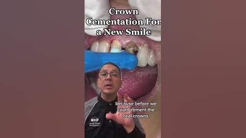 Smile Makeover: Replacing the Front Teeth with Porcelain Crowns | View Mobile Dental