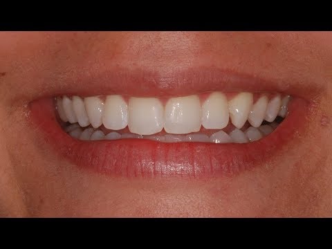 Como Faço Para Acostumar a Comer com Prótese Dentária Removível?