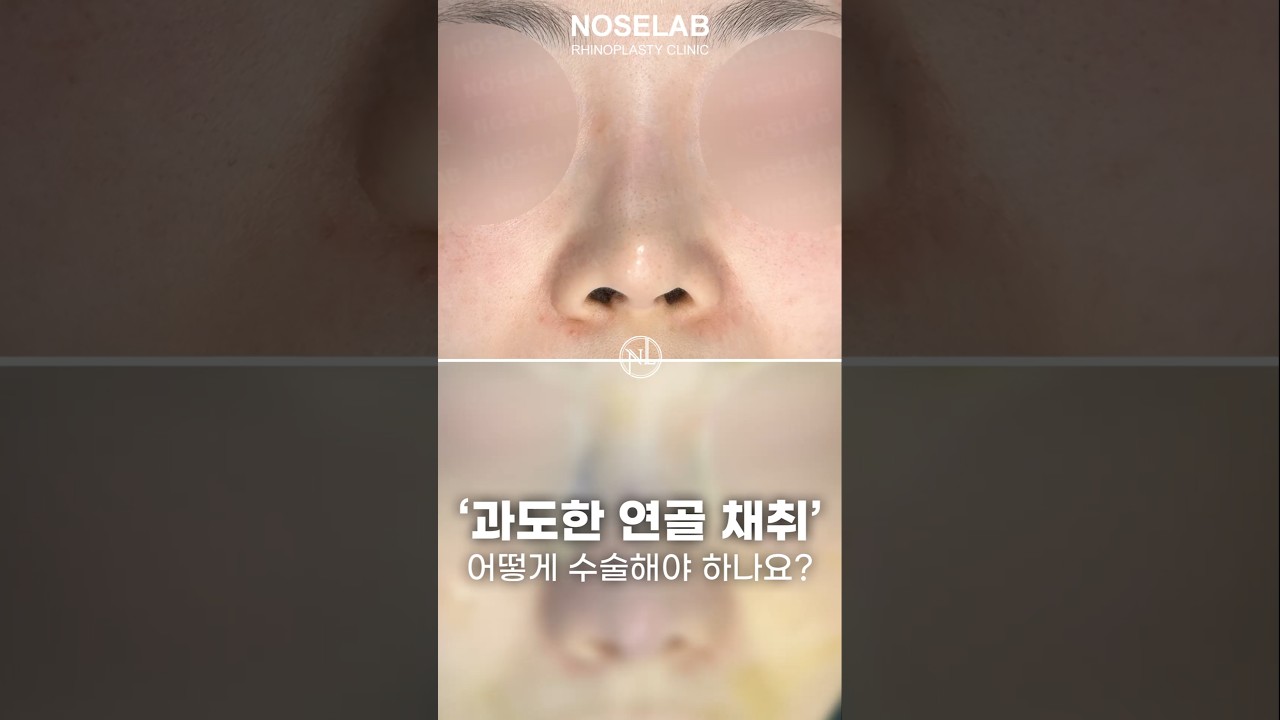 코재수술 10년 만에 찾은 이상적인 코 라인, 비중격 재건이 중요한 이유