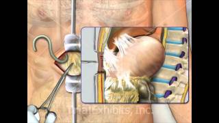 Placement of Lumbar Peritoneal Shunt - Trial Exhibits Inc.