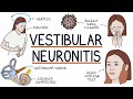 Understanding Vestibular Neuronitis