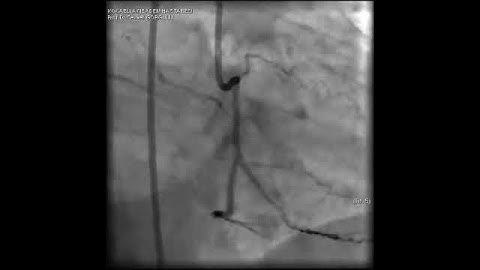 Complex PCI for RCA CTO with bifurcation at distal cap video 15