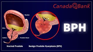 Benign Prostatic Hyperplasia (BPH)