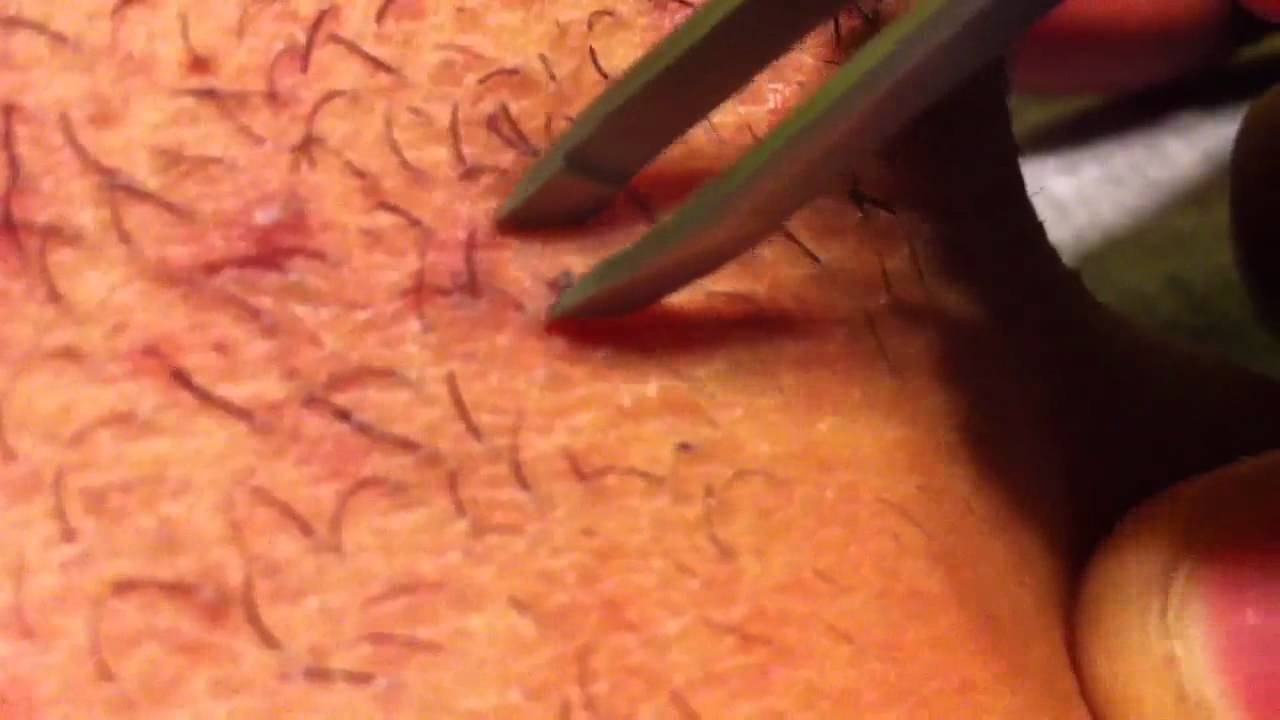 WORLDS BIGGEST INGROWN HAIR YouTube