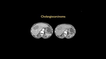 Cholangiocarcinoma