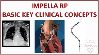Impella Rp, Basic Key Clinical Concepts