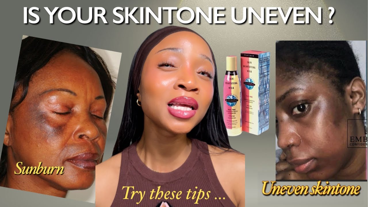 How to get rid of Dryness, Sunburn & Uneven skintone on the face. 