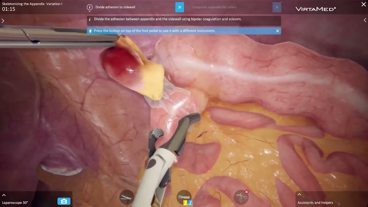 Exposure of Structures - Pre-ileal Appendix