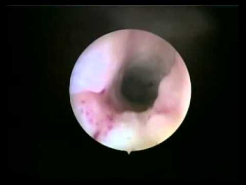 Video: Biopsija Desni: Vrste, Svrha I Postupak
