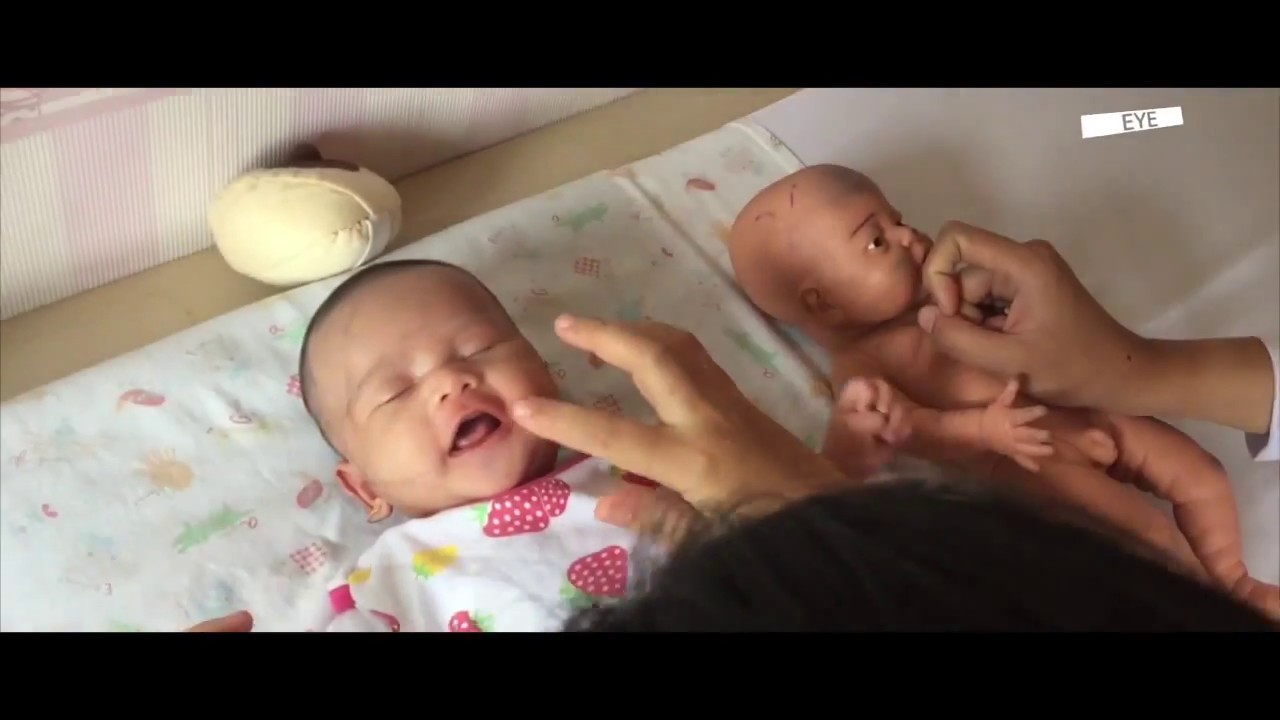 LIDAH BAYI SETELAH OPERASI TONGUE TIE & LIP TIE BEGINI SENAM TERBAIKNYA