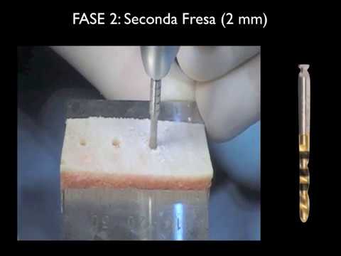 Piezosurgery dentale orale e impianto dentale sistema motorio piezoelettrico chi