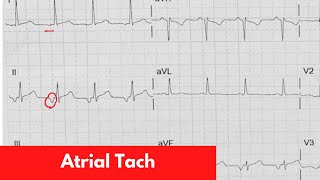 Atrial Tach | For DO, MD, NP, PA [Part 4]